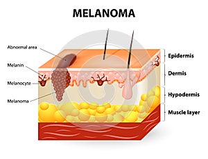 Melanoma or skin cancer