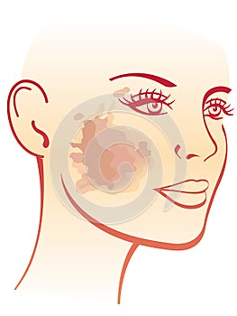 Melasma illustration