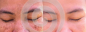 Melasma pigmentation facial treatment. photo