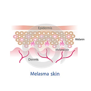 Melasma skin layer .