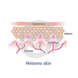 Melasma skin layer . photo