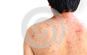 Men with acne, with red spots on the back