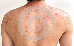 Men with acne, with red spots on the back