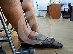 Men with diabetes and kidney disease With swelling feet. Can not wear shoes. he was in a wheelchair in the hospital for a battle t