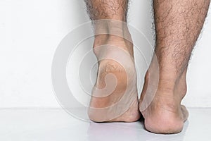 Men a feet skin cracked heels