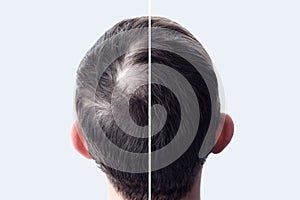 Men hair after using cosmetic powder hair thickening. Crown with bald head. Before and after