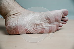 Men`s feet with cracked, unkempt skin after paresis of the lower extremities.