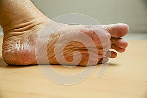 Men`s feet with cracked, unkempt skin after paresis of the lower extremities. photo