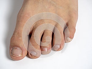 Men`s foot problems on the skin and on the nails