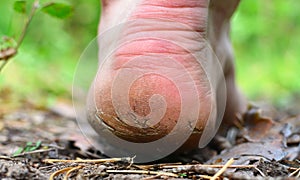 Men`s foot with rough skin and a dry heel with many cracks. The concept of health problems, poor self-care.