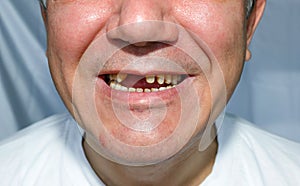 Men smile peeled upper teeth