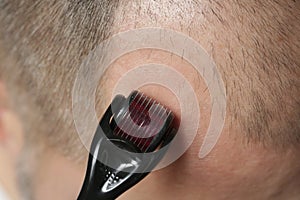 Men using microneedle derma roller on head for stimulating new hair growth.
