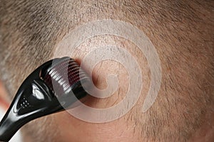 Men using microneedle derma roller on head for stimulating new hair growth.