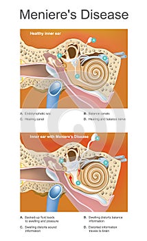 Meniere disease. Illustration. Disorder of the inner ear that ca