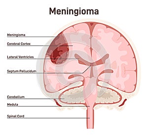 Meningioma. Brain tumor that forms from the meninges, the membranous