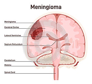 Meningioma. Brain tumor that forms from the meninges, the membranous photo