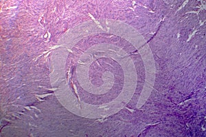 Meningioma, light micrograph, photo under microscope