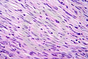 Meningioma, light micrograph, photo under microscope