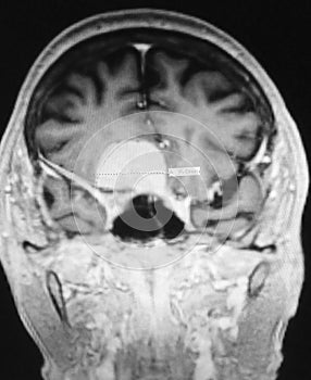 Meningioma mri image radiological examination