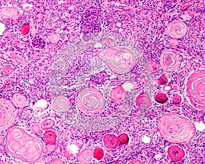 Meningioma. Psammoma bodies photo