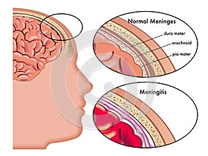 Meningitis photo