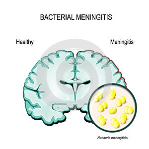 Meningitis. Human brain and meningococcal bacteria. photo