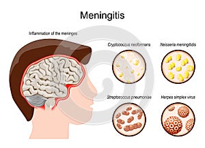 Meningitis. Human`s brain with Inflammation of the meninges and Pathogens photo