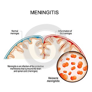 Meningitis. brain with Normal meninges and Inflammation of photo