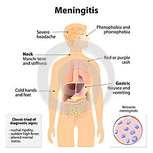 Meningitis photo