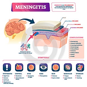 Meningitis vector illustration. Labeled brain membrane inflammation scheme.