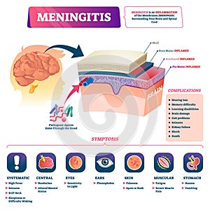 Meningitis vector illustration. Labeled brain membrane inflammation scheme. photo