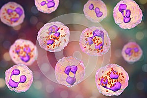 Meningococcal meningitis, cerebrospinal fluid smear