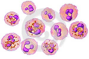 Meningococcal meningitis, cerebrospinal fluid smear photo