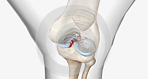 Meniscal root tears are less common than meniscal body tears and frequently go undetected photo