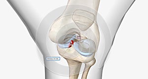 Meniscal root tears are less common than meniscal body tears and frequently go undetected photo