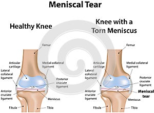 Meniscal Tear