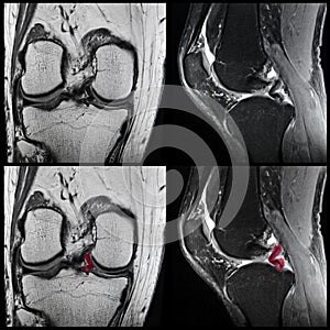 Knee ligament tear, MRI photo