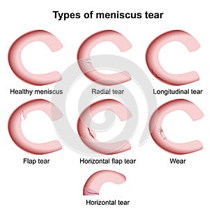 Meniscus injuries medical vector illustration isolated on white background, meniscus tear