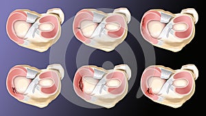 Meniscus injury