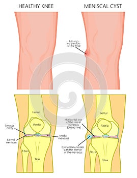 Meniscus _Meniscal cyst front view