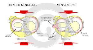 Meniscus _Meniscal cyst photo