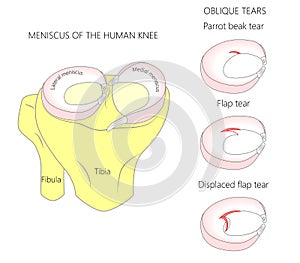 Meniscus _Oblique tears photo