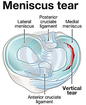 Meniscus tear anatomy. Labeled illustration