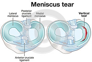 Meniscus tear. Labeled illustration