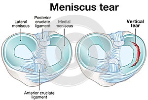 Meniscus tear. Labeled illustration photo