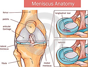 Meniscus tear and surgery