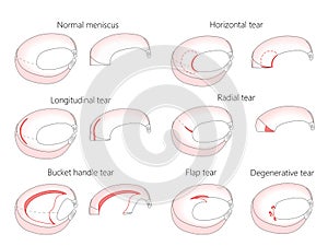 Meniscus _Tear types photo