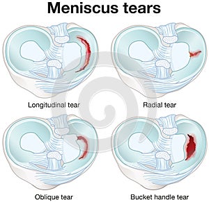 Meniscus tears. Anatomy, injury. Labeled Illustration photo