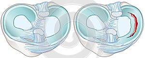 Meniscus tears anatomy. Medically illustration