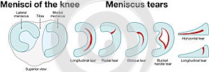 Meniscus tears of the knee joint. Anatomy, injury. Labeled Illustration photo